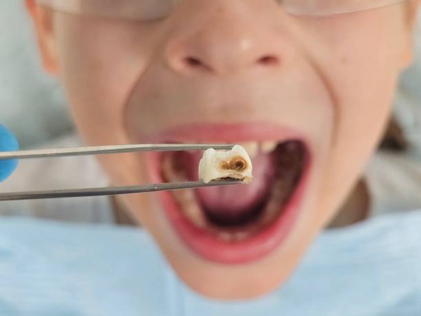 Best Emergency Dental Extractions in Luling, TX